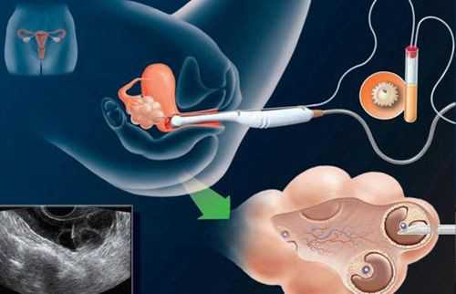 37岁试管代生,试管婴儿低胎盘位置对妊娠影响浅析